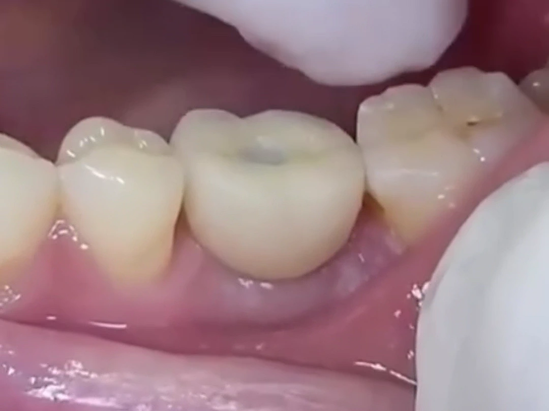 La corona definitiva colocada sobre el implante, entre los dientes vecinos